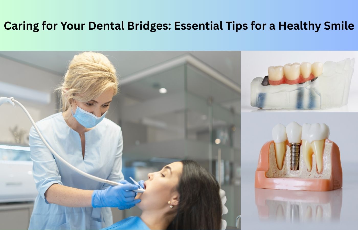 Dental Bridges